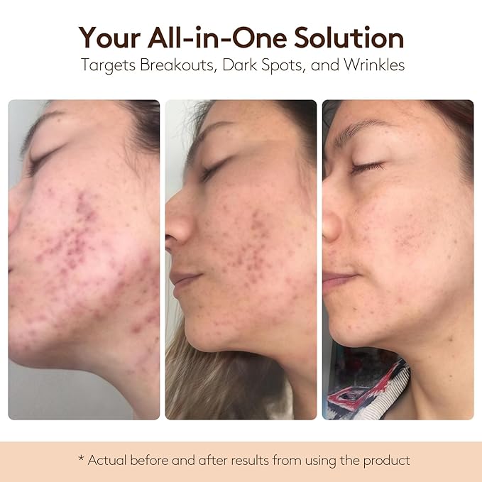 BIOCHEM DL-Mandelic Acid Facial Renewal Ampoule - Gentle AHA Exfoliation Treatment for Discoloration, Dullness, Uneven Skin Tone, Wrinkles, and Fine Lines for All Skin Types - 1.01 Fl. Oz. / 30 mL